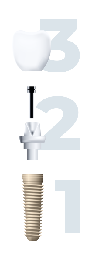 The parts of a dental implant.