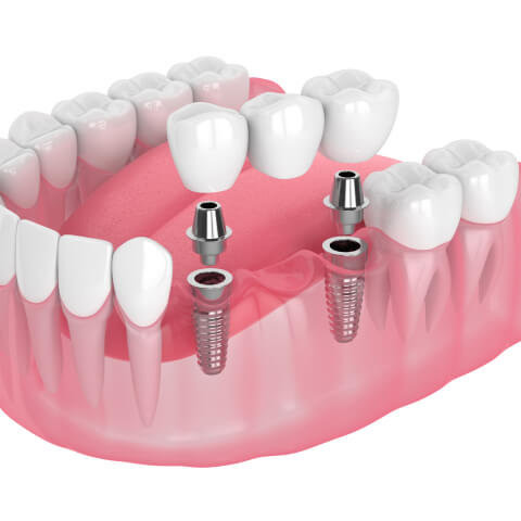 dental implants illustration.